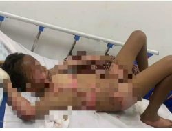 Mencuri Ikan Untuk Makan Bocah Balita Di Medan Di Bakar Hidup Hidup